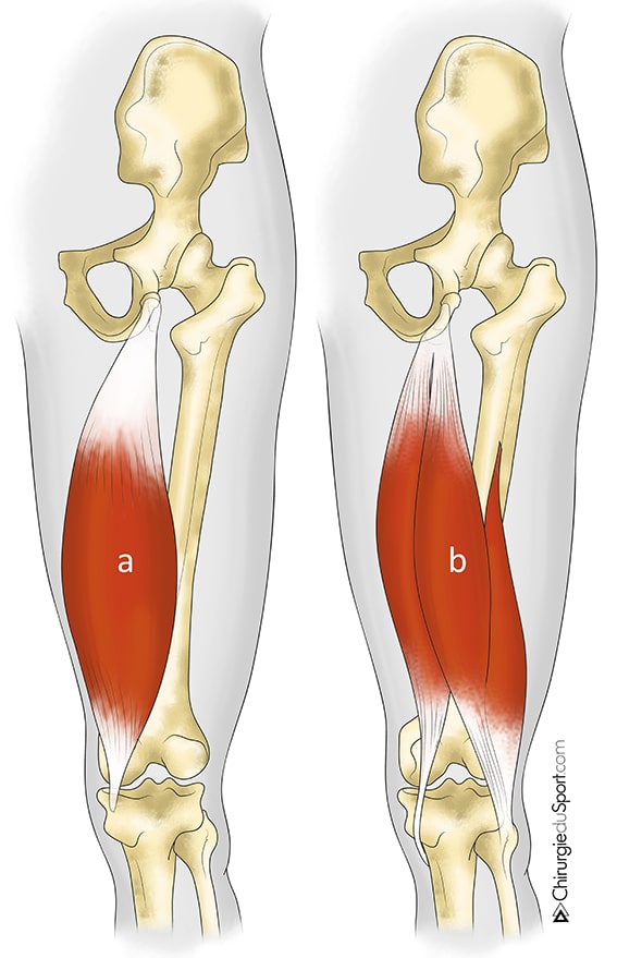 Rupture aigüe haute des tendons ischio-jambiers : résultats ...