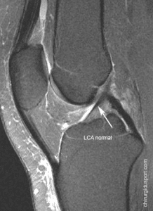Esguince rodilla anterior posterior). ACL: severo esguince de rodilla. – Chirurgie du Sport – Paris
