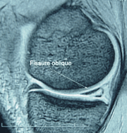 La lésion méniscale du sportif: traitement chirurgical par la ...