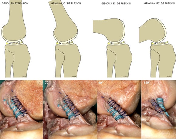 ORTESIS PARA EL CONTROL MEDIOLATERAL Y DE FLEXO-EXTENSION DE LA RODILLA (LIGAMENTO  CRUZADO ANTERIOR (LCA) Y/O POSTERIOR (LCP)