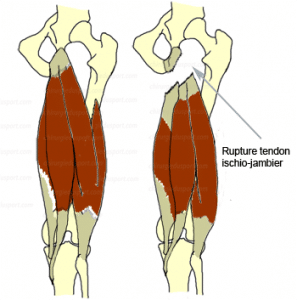 Rupture haute des tendons ischio-jambiers chez le sportif