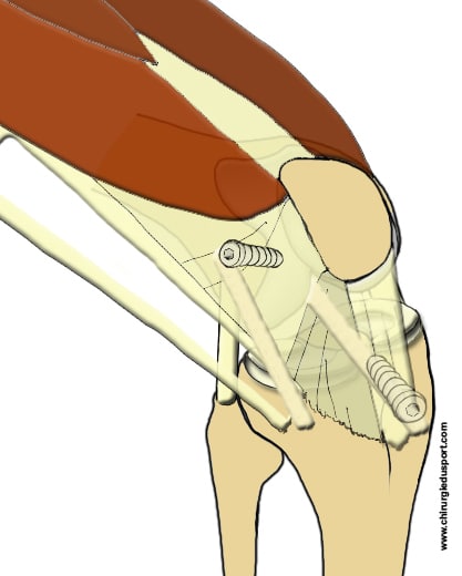 Ligamentoplastie du LCA : les techniques actuelles : DIDT, KJ, DT4 ...