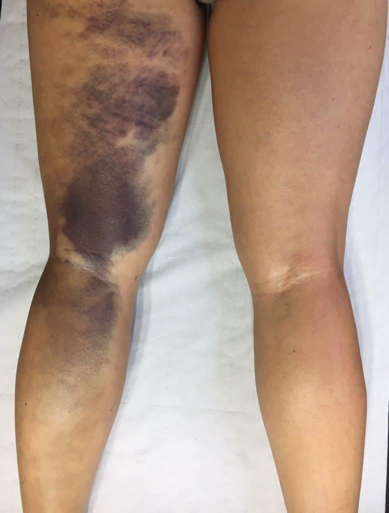 Hématome cuisse rupture ischio jambier - Chrirurgie du sport - Paris