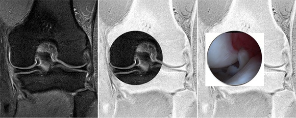 Ménisque fissuré, lésions, facture, déchirure – Chirurgie du Sport