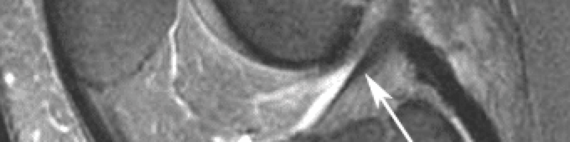 IRM_aspect_normal_LCA_ligament_croise_anterieur