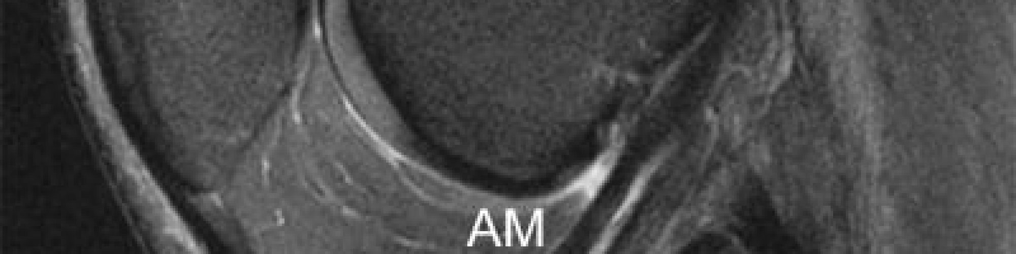 IRM_ligament_croise_anterieur_double_faisceau