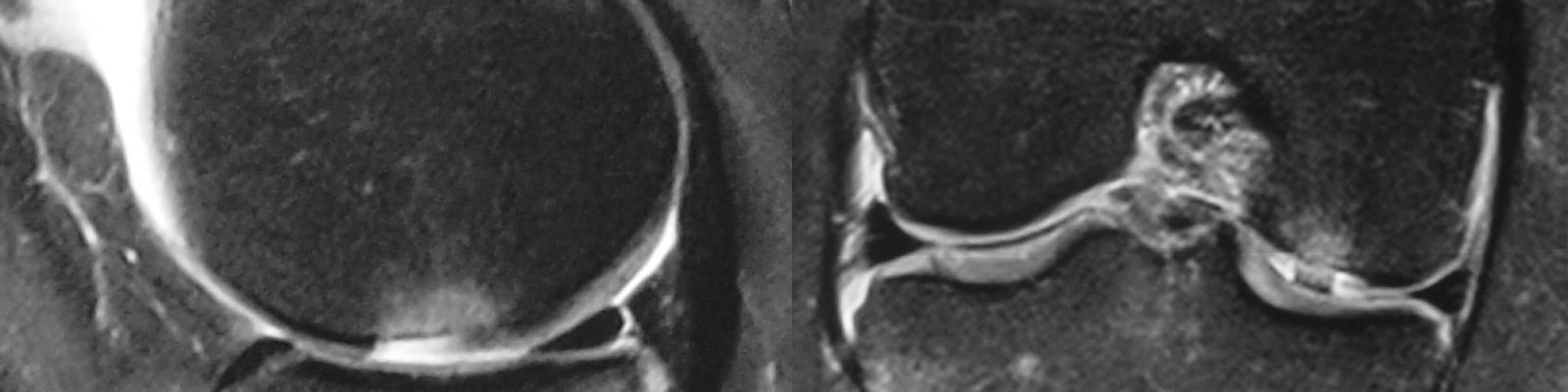 LESION-CHONDRALE-POST-TRAUMATIQUE-IMAGERIE-IRM-CHIRURGIEDUSPORT