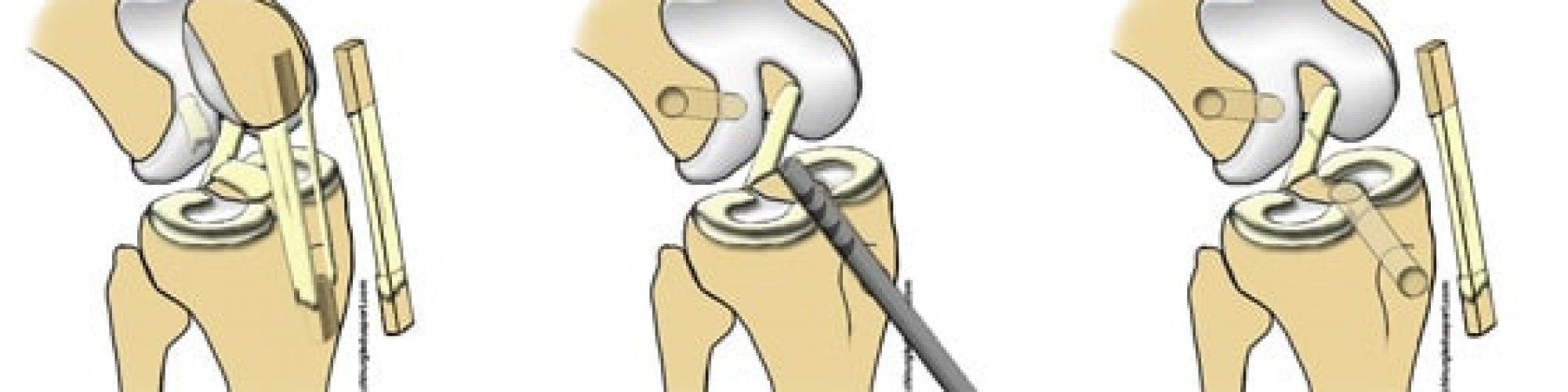 La_fiche_de_la_ligamentoplastie_type_KJ_kenneth_jones_chirurgiedusport-1