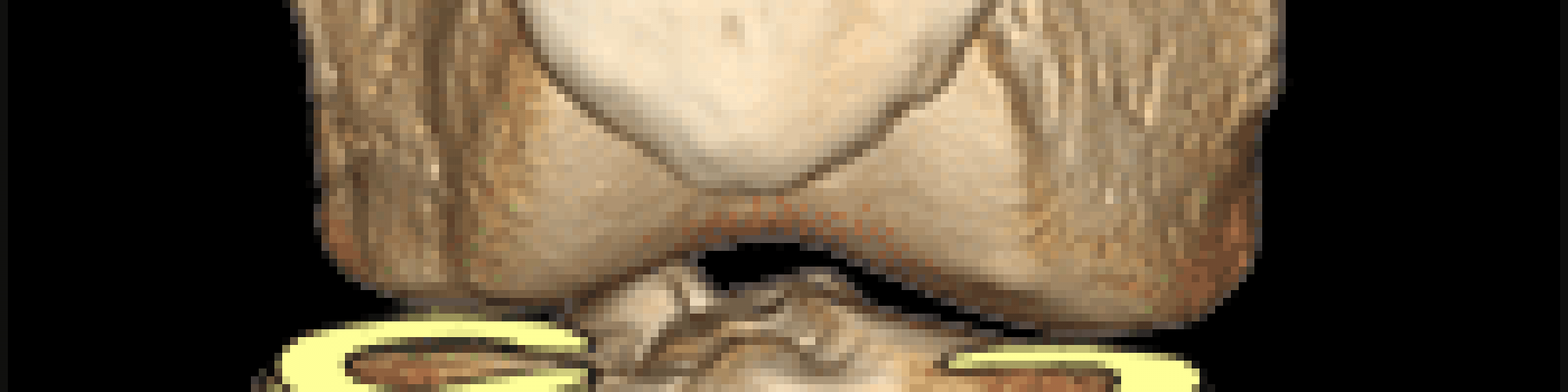 genou_menisque