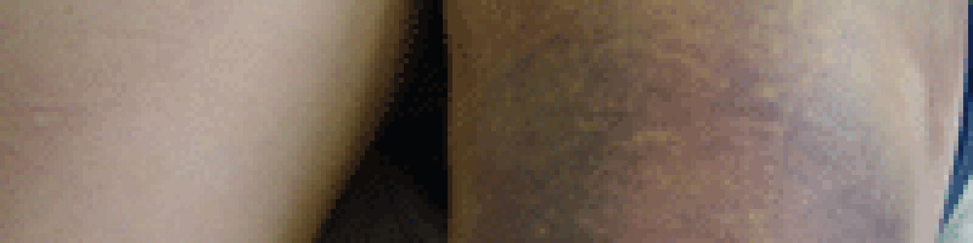 hematome_cuisse_rupture_ischiojambier