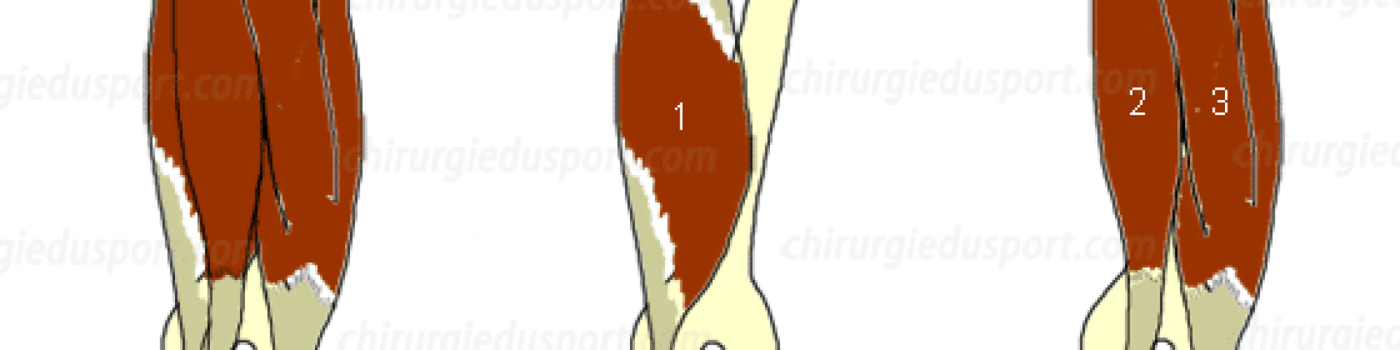 ischio-jambier_semi-tendineux_semi-membraneux_biceps