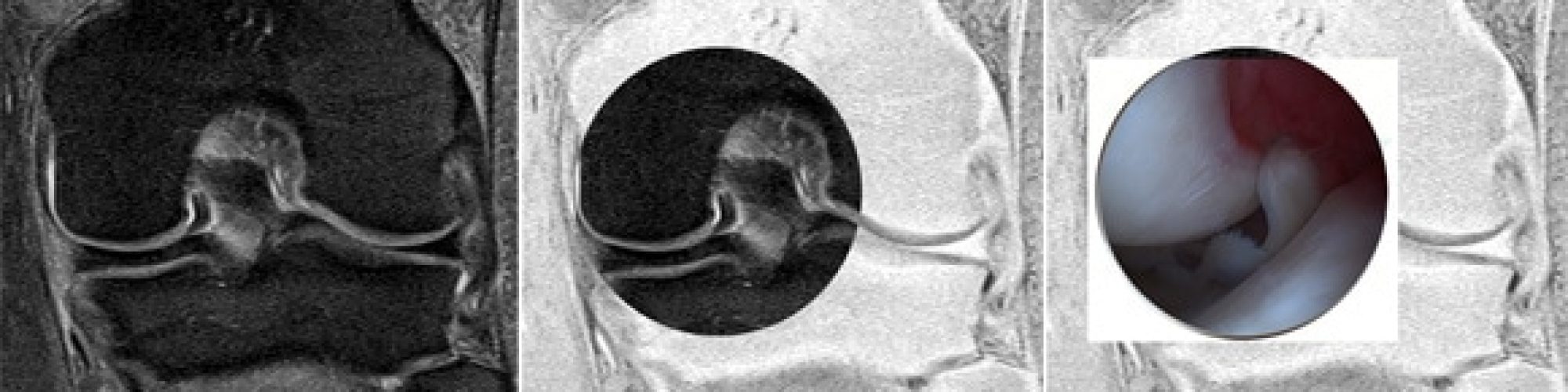 languette_menisque_genou_instable_luxee_menisques_arthroscopie_irm_centrage_petite