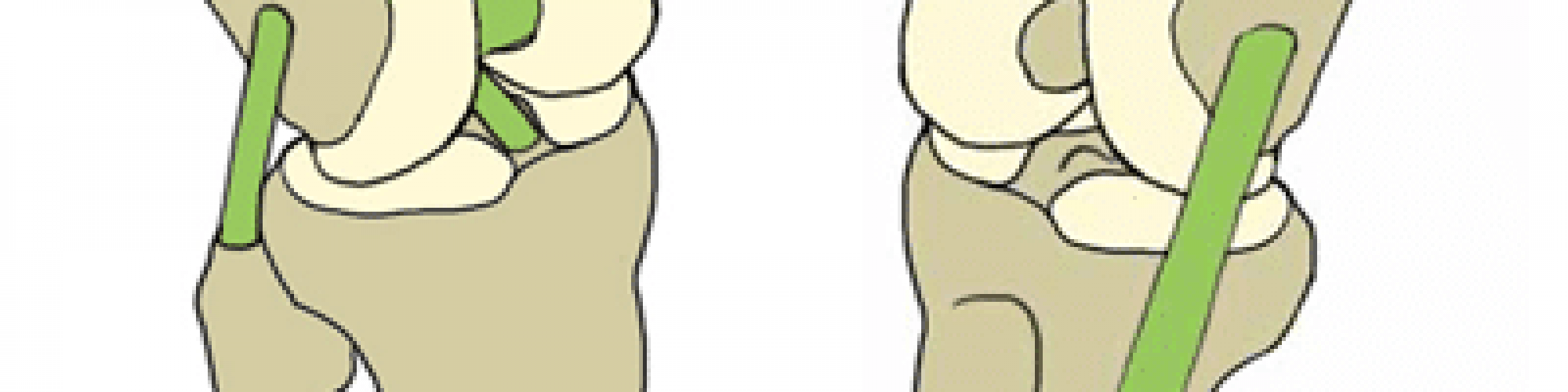 ligament_genou_interne_externe__
