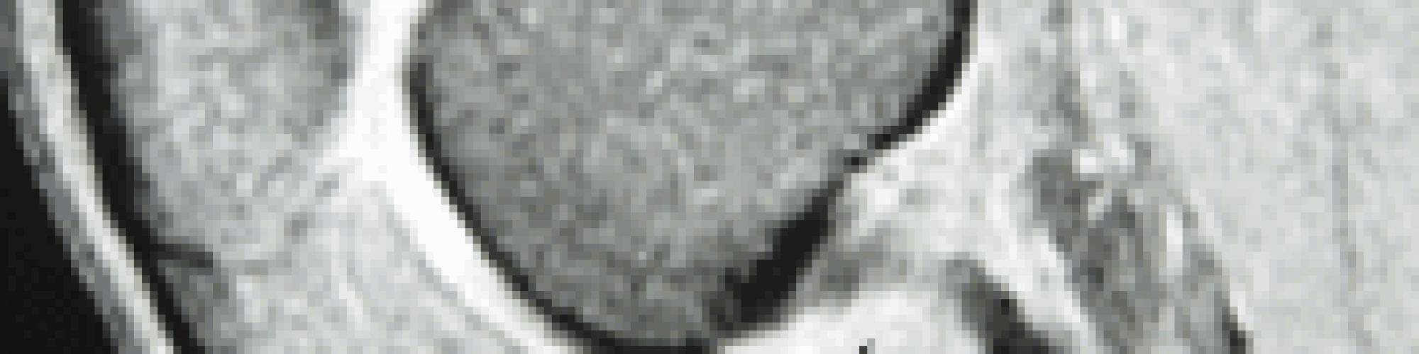photo_genou_profil_rupture-_lca-1