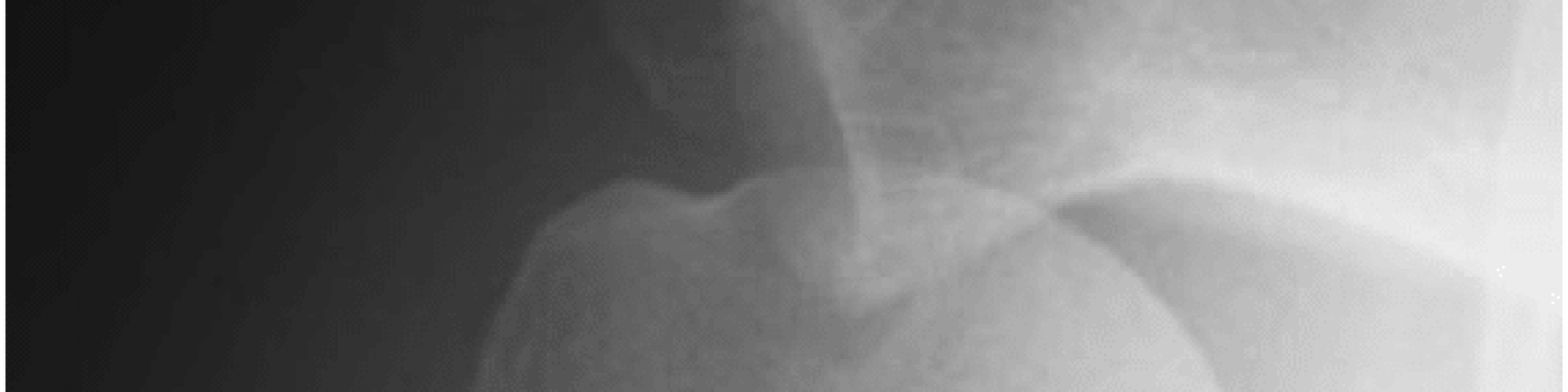 radio-luxation-epaule