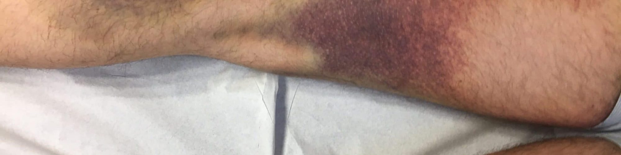 rupture_ischio_jambier_hematome_cuisse